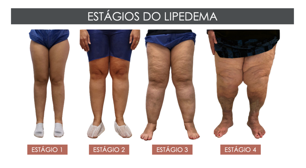 Lipedema: a doença progressiva do tecido adiposo que você deve conhecer -  mediQuo