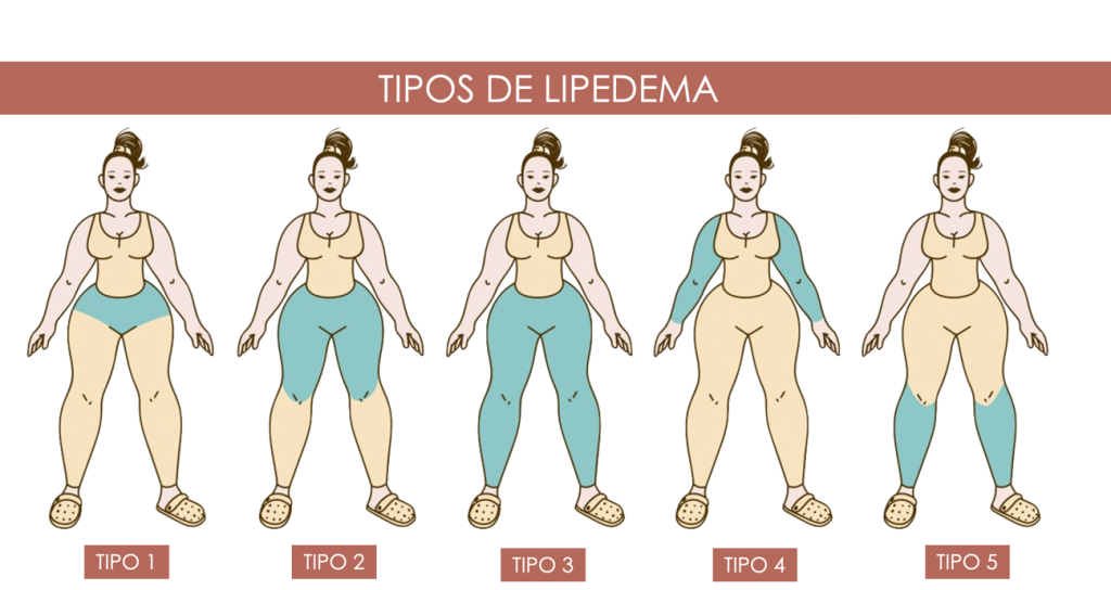 Lipedema: Entenda a diferença entre tumor de gordura e deposição